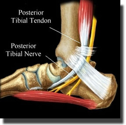 Tibial for Tendonitis shoes tendonitis posterior  Posterior tibial