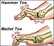 flexor stabilization contracted toes